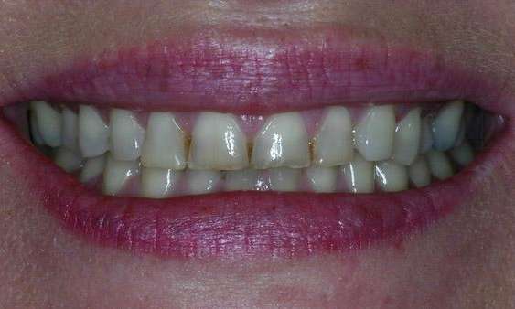 worn and discoloured teeth before whitening and veneers