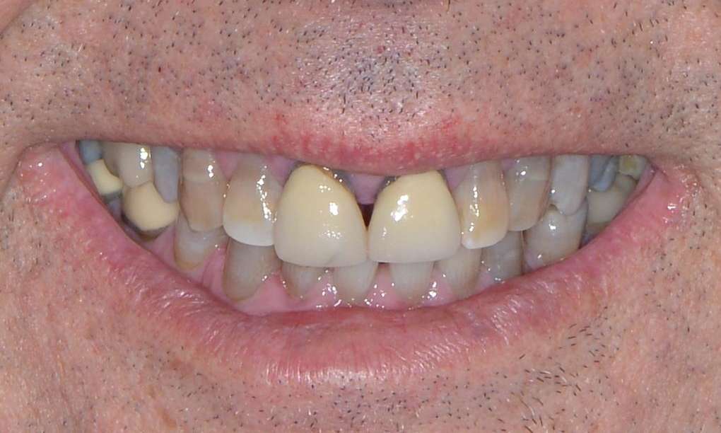 close cup of man's worn top teeth