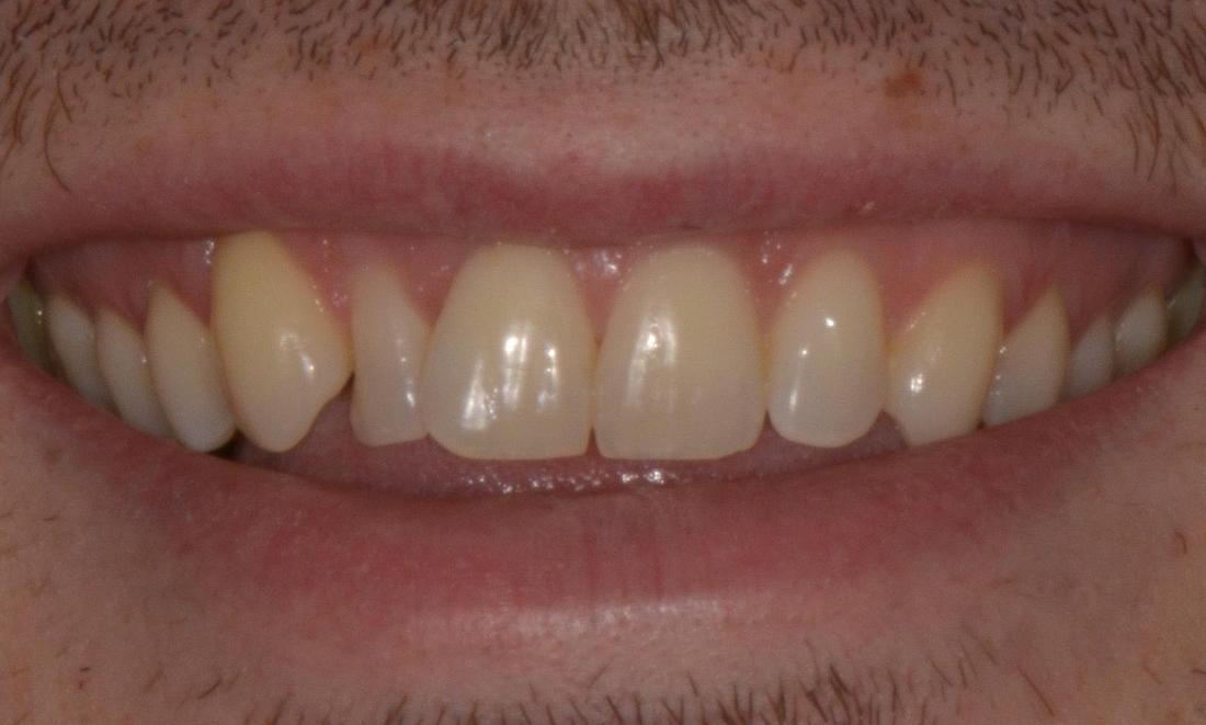 Patients smile before teeth whitening in Brisbane CBD