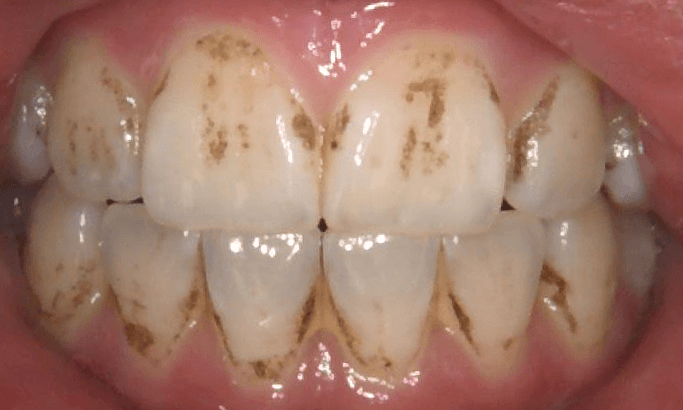 Discolored teeth before dental cleaning