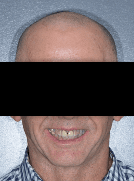 brisbane patient with worn top teeth
