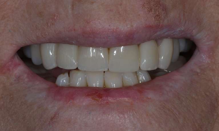 Porcelain Crowns Dr Malcolm Campbell After Image