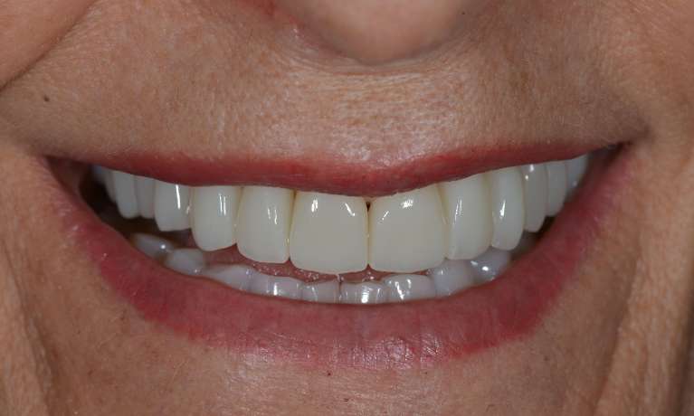 Brisbane Porcelain Crowns Same Day After Photo