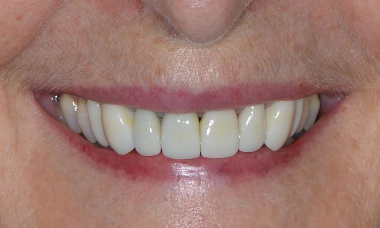 Porcelain crowns in Brisbane CBD after