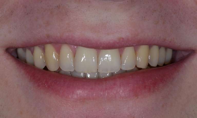 close up of patient's smile after invislaign