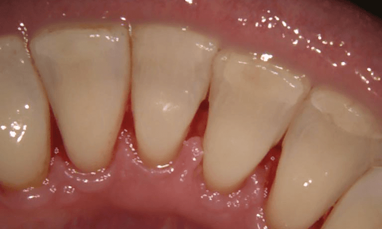 Periodontal-Management-After-Image