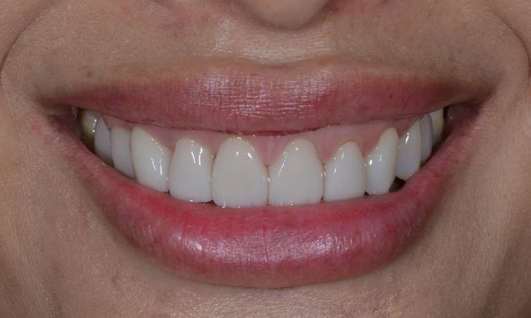 patient's smile after porcelain veneers on front teeth