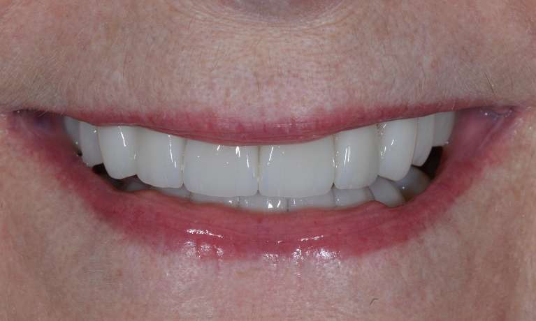 woman's uniform smile after veneers