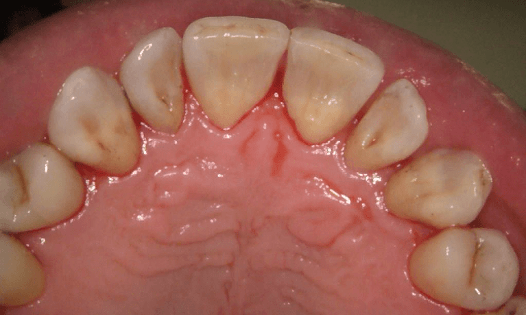 Thorough-Teeth-Cleaning-After-Image