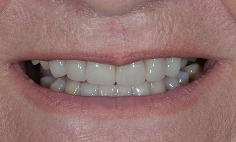 patient after getting upper and lower veneers