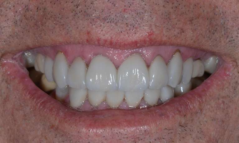 close up of patient's smile after getting cosmetic dentistry