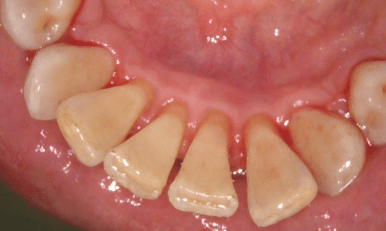 After teeth cleaning in Brisbane with air flow