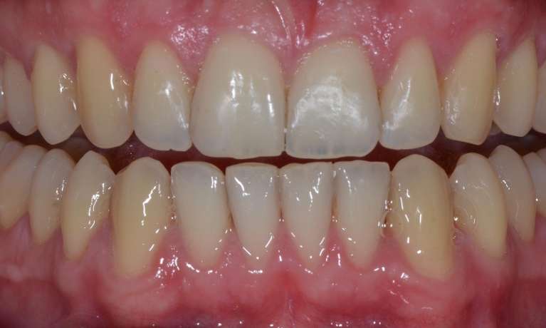 straight bottom teeth after invisalign