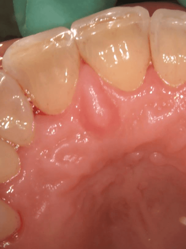 back of teeth after a thorough cleaning