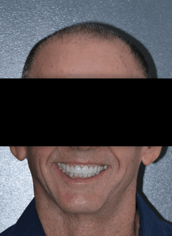 close up of patient's smile after getting cosmetic dentistry