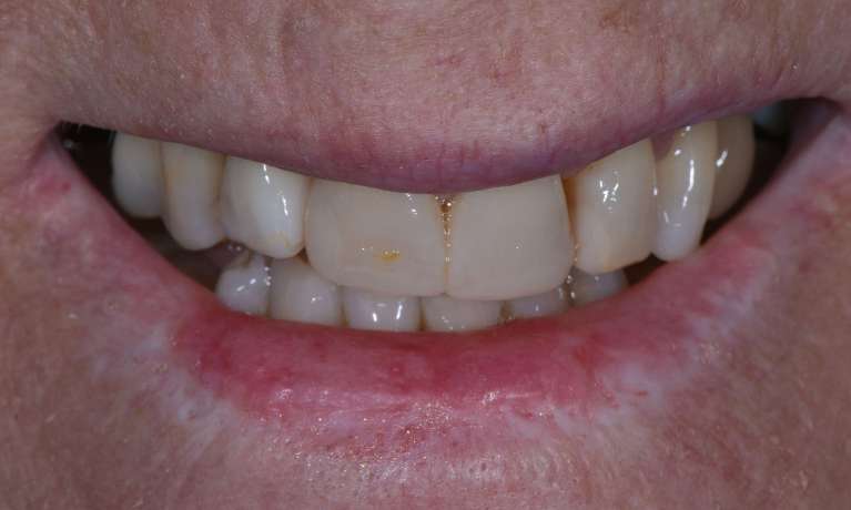 Porcelain Crowns Dr Malcolm Campbell before Image
