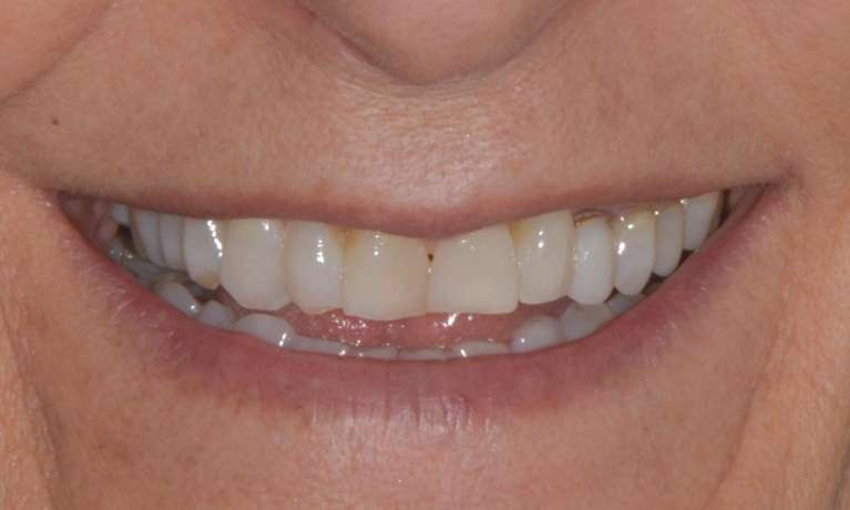 Brisbane Porcelain Crowns Same Day Before Photo
