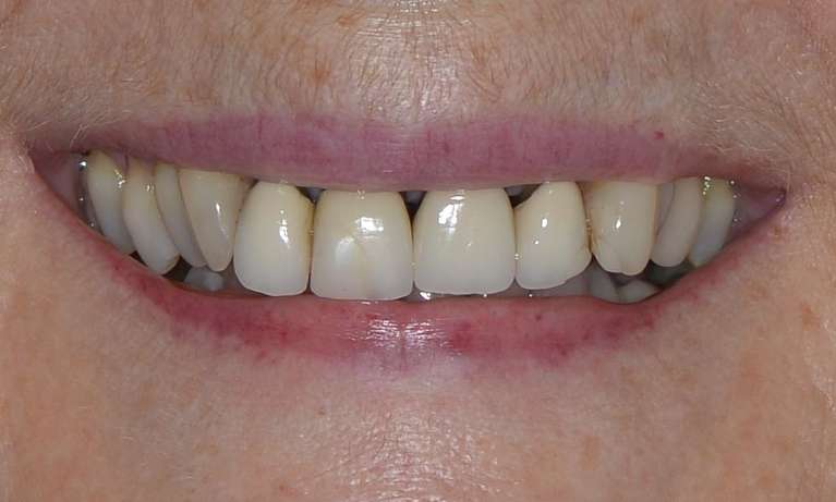 Porcelain crowns in Brisbane CBD Before