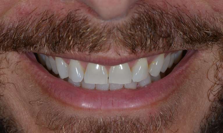 Veneers in Brisbane CBD before image