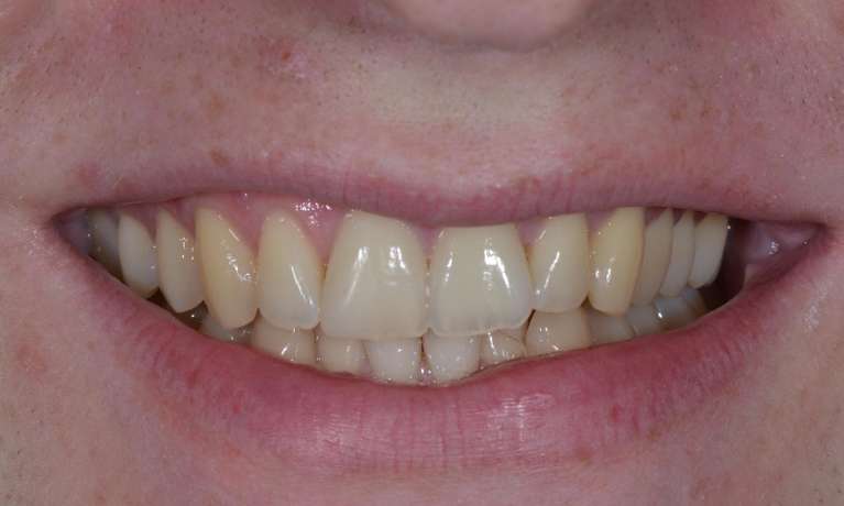 close up of patient's smile before invisalign