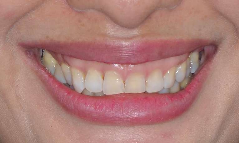 woman with discolured teeth before veneers