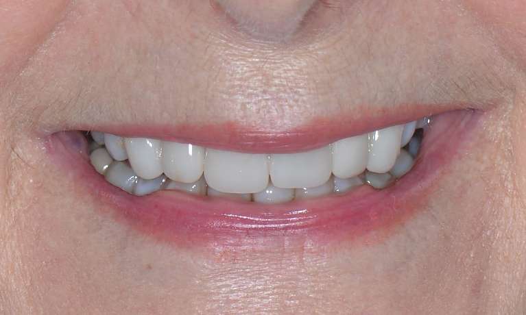 Replacement of existing veneers
