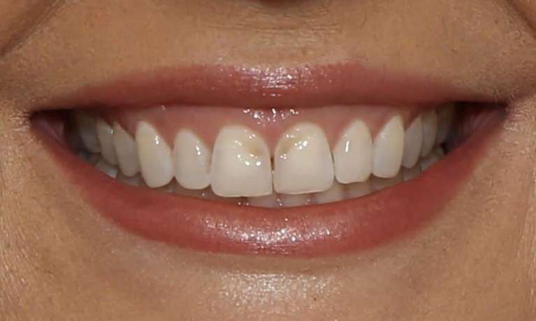 Brisbane Dentist Upper Veneers