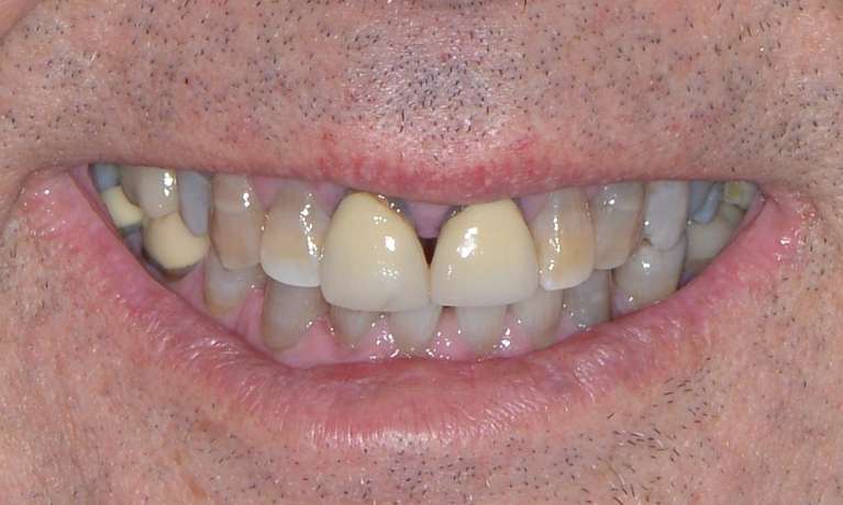 close cup of man's worn top teeth