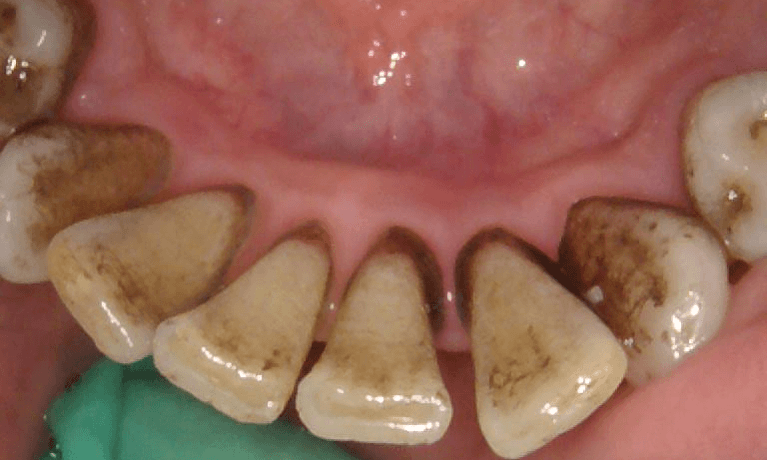 Before teeth cleaning in Brisbane