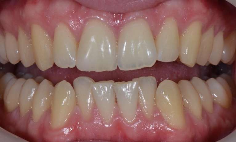 Crowded bottom teeth before invisalign