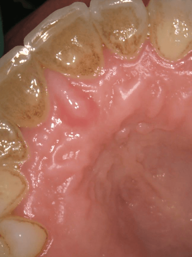 yellowed backs of teeth with periodontal issues